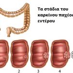 ΚΑΡΚΙΝΟΣ ΠΑΧΕΟΣ ΕΝΤΕΡΟΥ